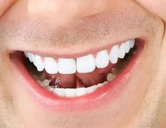 龈下刮治后牙龈会重新包紧牙吗？牙周刮治可以一次性全口刮治